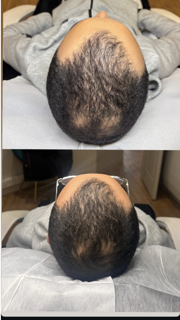 Résultat mésothérapie capillaire Paris homme