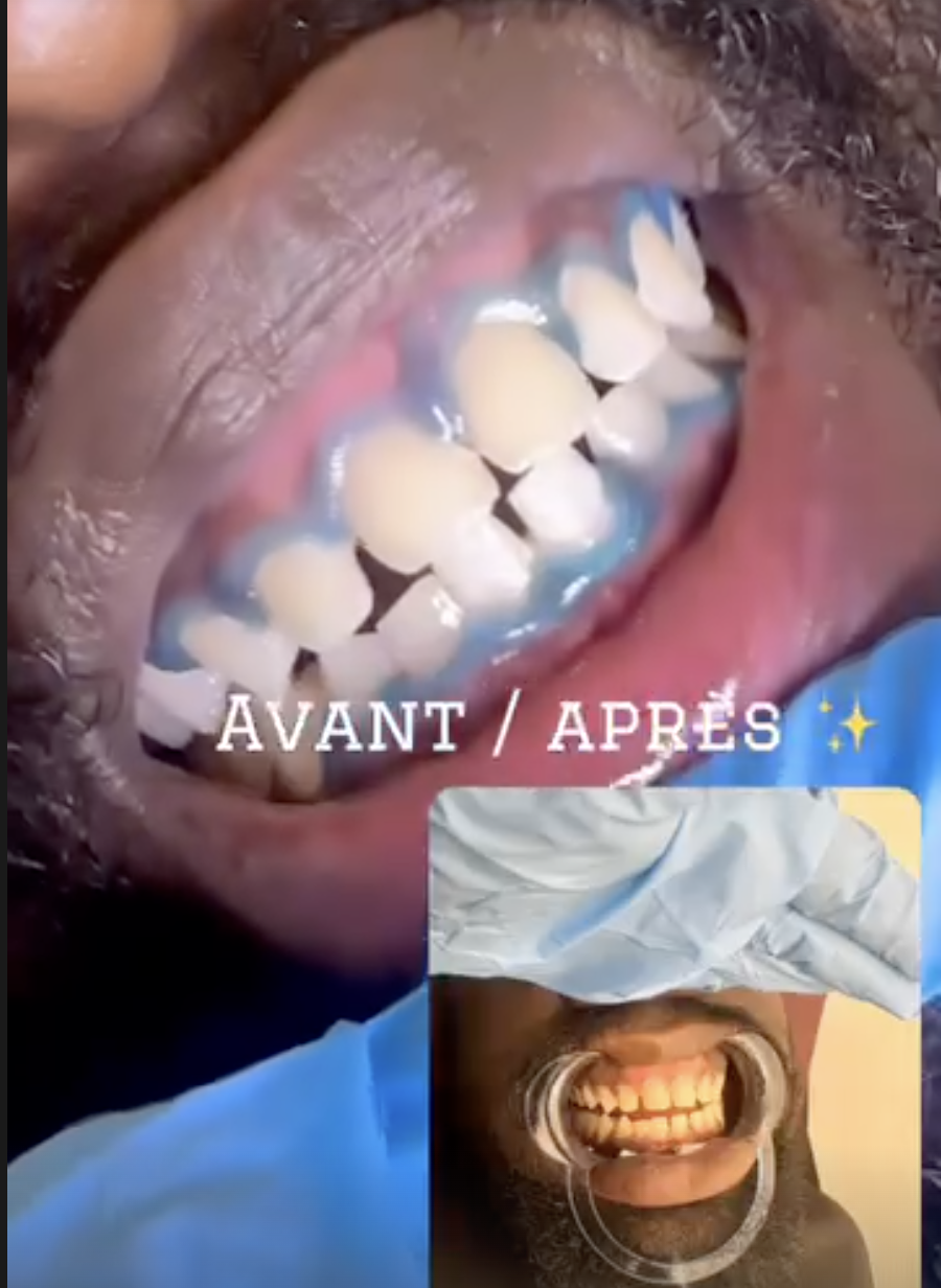 Sourire éclatant homme blanchiment Paris 17 avant après