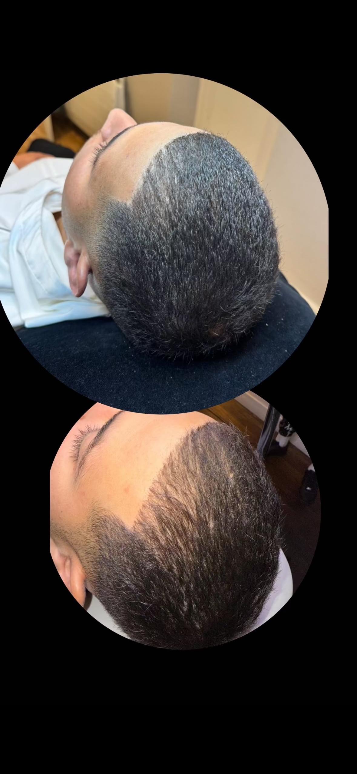 Avant après Estheban
