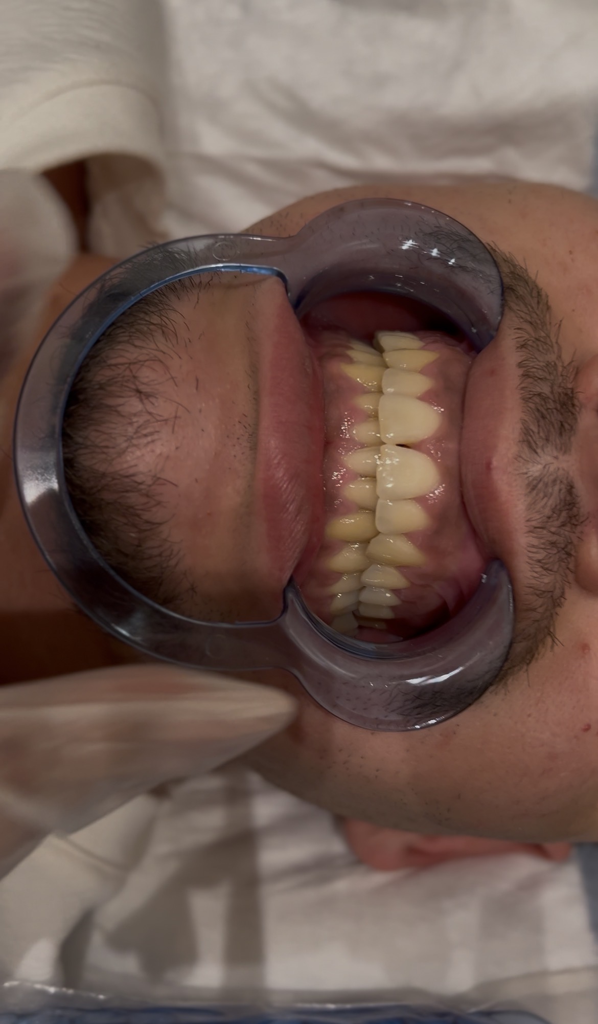 Dents homme avant blanchiment Paris