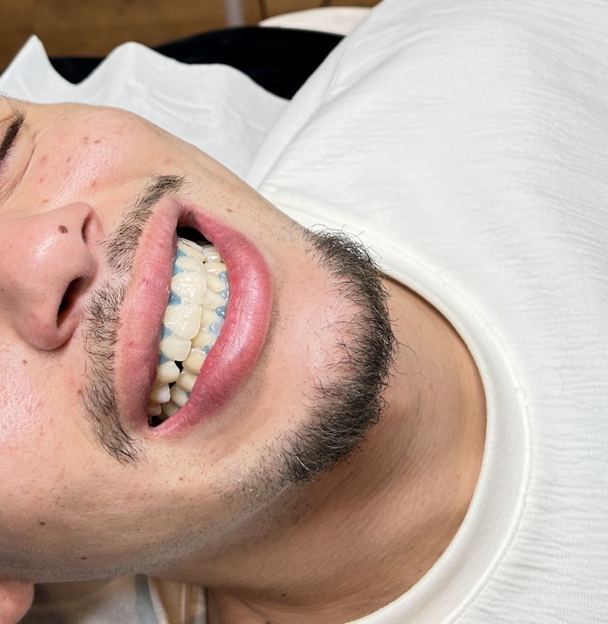 Retouche sourire Aesthetic Men Paris 17